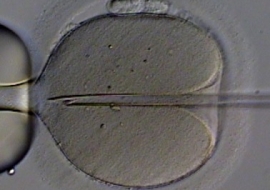 Tecinca di Fecondazione Assistita ICSI Iniezione intracitoplasmatica dello spermatozoo