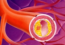 Aterosclerosi: diagnosi e trattamento